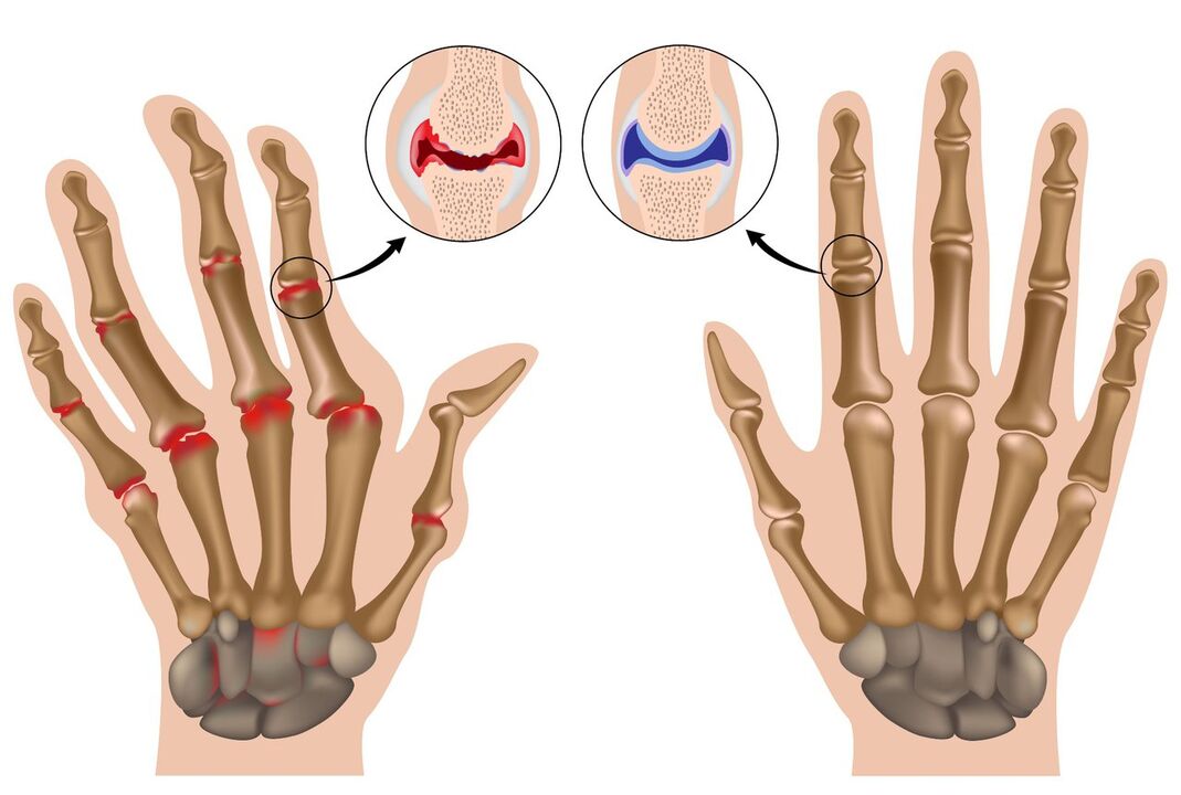 Healthy hand joints affected by polyarthritis