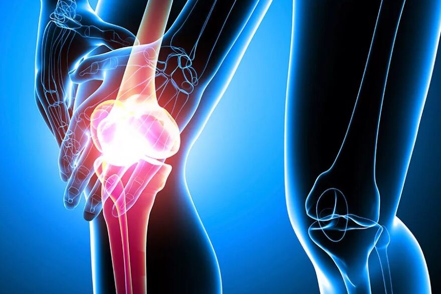 Knee arthrosis
