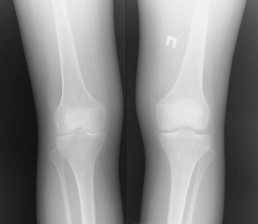 Knee joint radiography