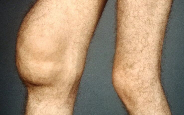Post -traumatic arthrosis of knee joint