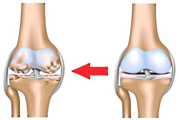 Healthy Articulation and Arthrosis
