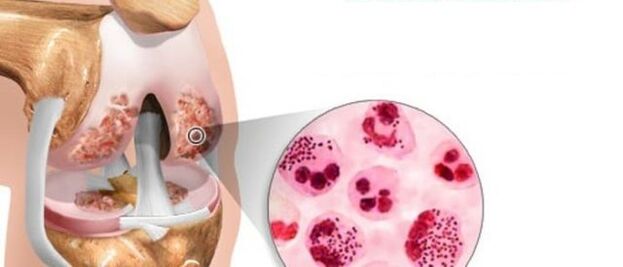 What leads to the development of arthrosis