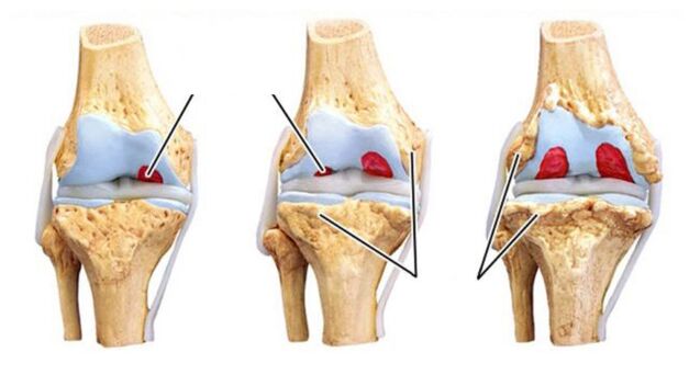joint arthrosis complications