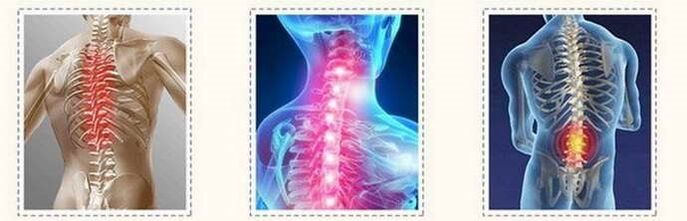 Spinal lesions of osteochondrosis