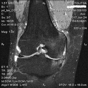 Knee joint osteoarthritis on MRI