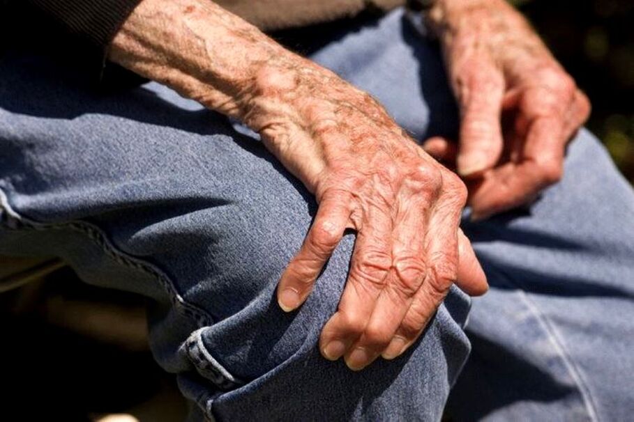 Osteoarthritis is an age-related disease that occurs in elderly people